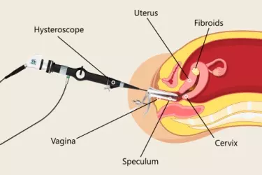 Hysteroscopy in Bihar, Best Gynecologist for Hysteroscopy in Purnia, Diagnostic Laparoscopy in Bihar, Best Hospital for Hysteroscopy, Cost of Hysteroscopy in Purnia, Bihar, Dr Ruchi Soumya, Best Doctor for Hysteroscopy in Bihar